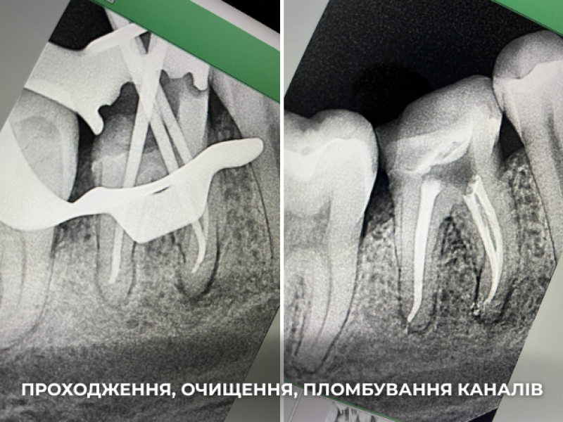 галерея лікування каналів 2