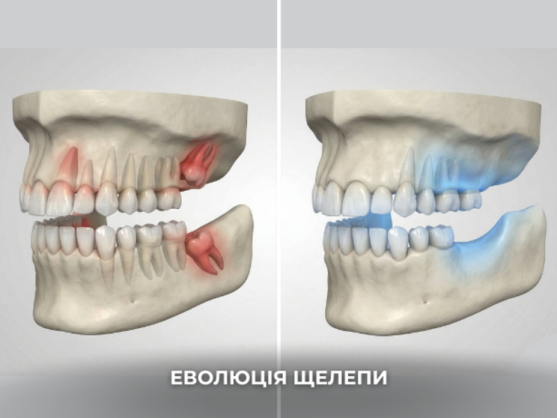 зуби мудрості